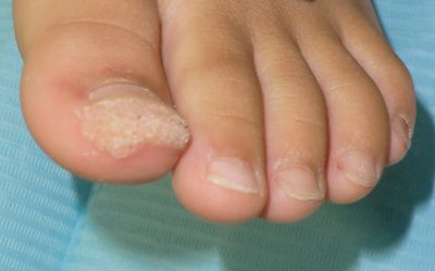 PAPILOMAS VERSUS VERRUGAS PLANTARES